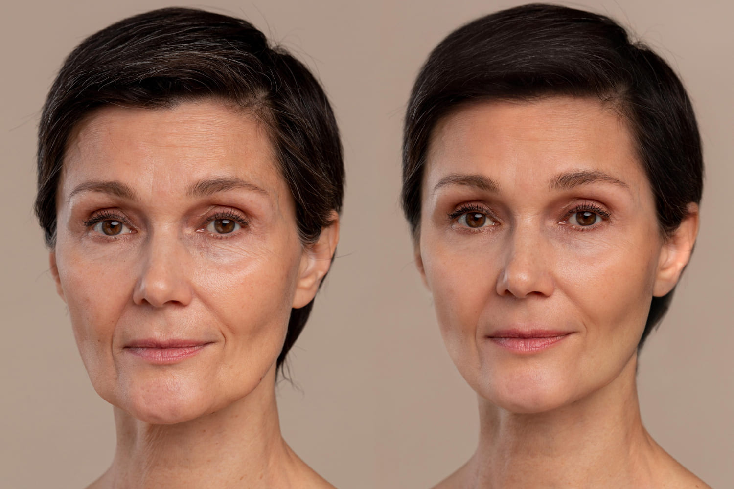 Rejuvenecimiento Facial y Corporal con Morpheus 8 en CDMX y Edo. Mex.